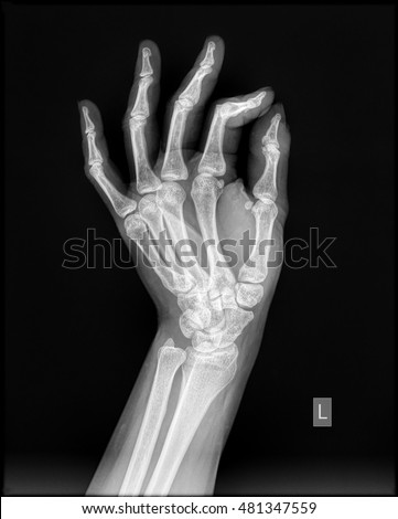 Left hand x-ray in lateral view of healthy subject
