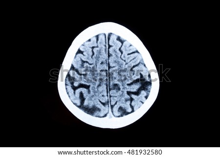 X-Ray image of human brain