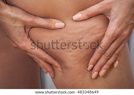 Girl shows holding and pushing the skin of the legs cellulite, orange peel. Treatment and disposal of excess weight, the deposition of subcutaneous fat tissue Royalty-Free Stock Photo #483348649