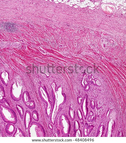 Microscope picture of colon cancer