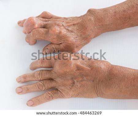 Fingers of patient with gout. Royalty-Free Stock Photo #484463269