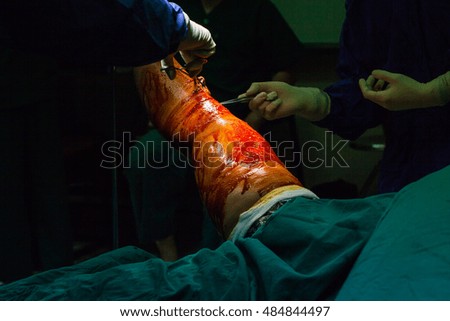 Traumatology orthopedic surgery hospital emergency operating room prepared for knee torn meniscus arthroscopy operation photo.