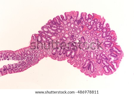 Microscopic image of an adenoma. Adenomas are premalignant (precancerous) polyps of the colon and rectum. Colonoscopy can prevent cancer by removing adenomas before they transform to cancer. Royalty-Free Stock Photo #486978811