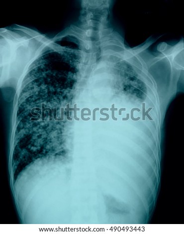 X ray film of patient with lung cancer.