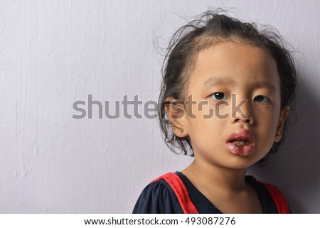 Portraiture of kid injuries on lips with available low light photography