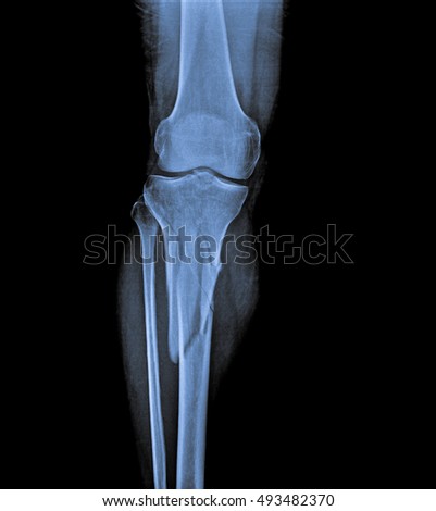x ray of fracture tibia, injured leg.