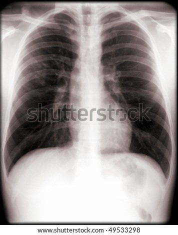 human chest x-ray, elderly person