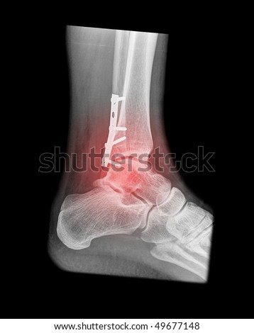 painfull foot fracture with red illumination on black background Royalty-Free Stock Photo #49677148