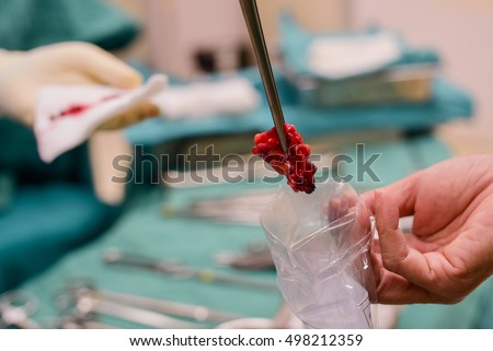 Surgical biopsy specimens Royalty-Free Stock Photo #498212359