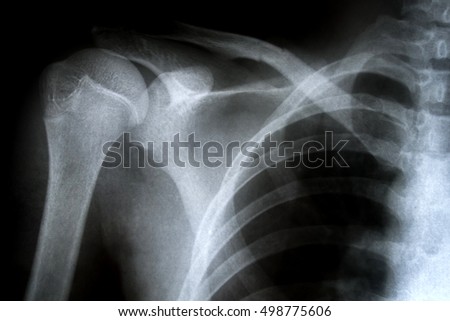 X-ray film of shoulder fracture.