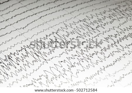 Abnormal EEG on brain wave background,Epileptiform discharge