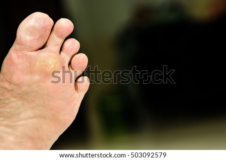 wart under foot can treatment by salicylic acid. wart can treat with treatment by salicylic acid. wart on the foot verruca freeze concept blurred neutral background, selective focus, Royalty-Free Stock Photo #503092579