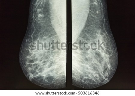 Close up Mammography x-ray picture.