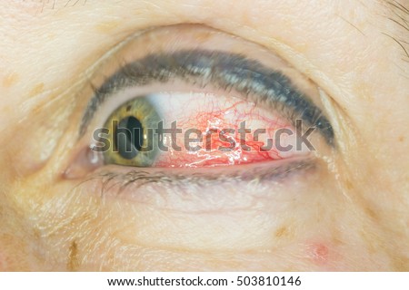 close up of episcleritis during eye examination.