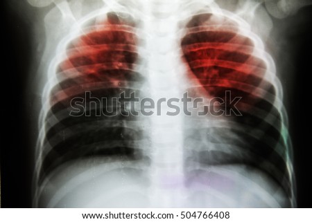 Pulmonary Tuberculosis ( TB ) : Chest x-ray show alveolar infiltration at both lung due to mycobacterium tuberculosis infection Royalty-Free Stock Photo #504766408
