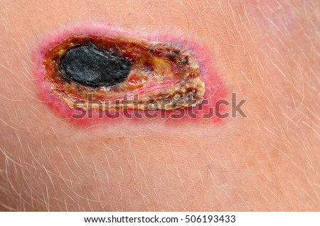 A necrotic scab on a human leg Royalty-Free Stock Photo #506193433