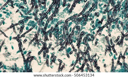 Fungus Infection of Lung, Microscopic Image: A silver stain (GMS) reveals fungal hyphae of Aspergillus in cytology cell block specimen obtained during endoscopy (broncohalveolar lavage (BAL)). Royalty-Free Stock Photo #506453134