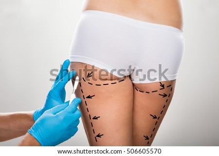 Close-up Of Surgeon Hand Holding Scalpel On Woman's Leg Marked With Lines