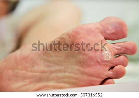wart under foot can treatment by salicylic acid. wart can treat with treatment by salicylic acid. wart on the foot verruca freeze concept blurred neutral background, selective focus, Royalty-Free Stock Photo #507316552