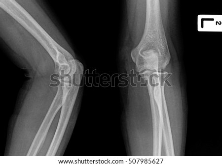 film x-ray elbow AP/Lateral