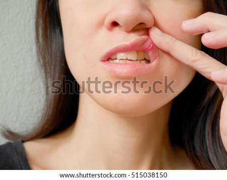 Canker sore on woman upper lip Royalty-Free Stock Photo #515038150