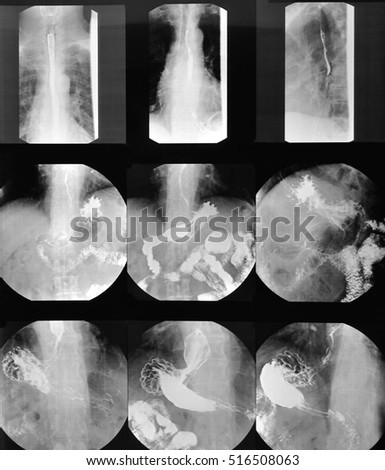  human esophagus, stomach, intestinal tract imaging X-ray pictures                               