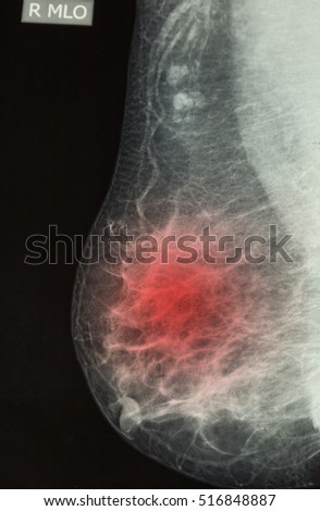 Mammography x-ray picture.