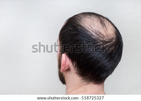 male head with thinning hair or alopecia Royalty-Free Stock Photo #518725327