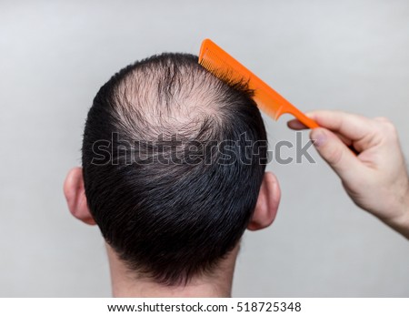 male head with thinning hair or alopecia Royalty-Free Stock Photo #518725348