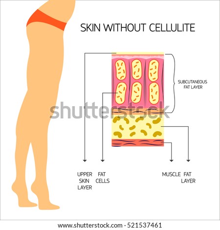 Cellulitis Vector illustration The structure of the adipose tissue with normal body weight and no cellulite Infographics