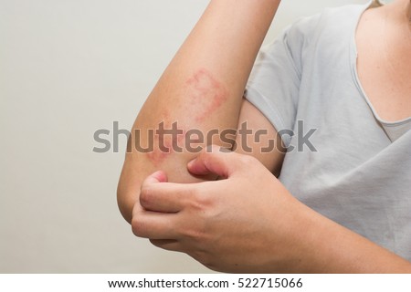 ill allergic rash dermatitis eczema skin of patient Royalty-Free Stock Photo #522715066