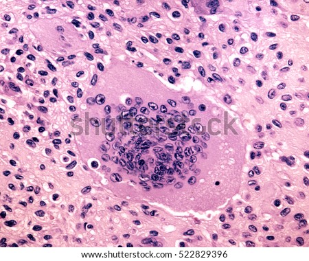 A mutinucleated giant cell derived from osteoclasts. Biopsy of a human giant cell tumour of bone. Light micrograph. Royalty-Free Stock Photo #522829396
