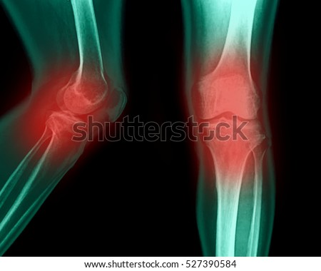 X-ray picture showing knee joints with arthrosis