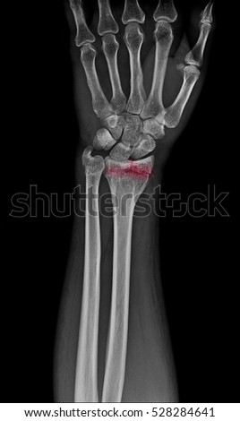 wrist x ray / x-ray show Distal Radius Fractures (Broken Wrist) mark with red color