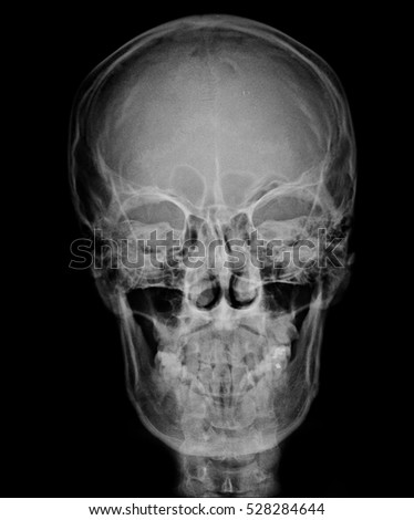 head skull x-ray front view 
