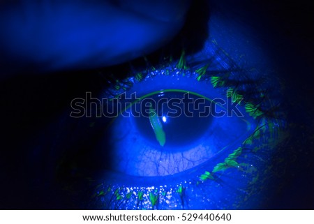 close up of corneal abrasion during eye examination. in dark room. Royalty-Free Stock Photo #529440640