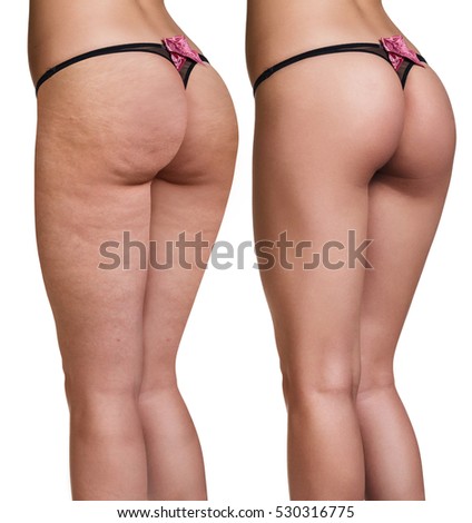 Female buttocks before and after cellulite