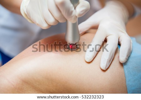The process of aesthetic laser correction procedure of scars and stretchs on the body in the medical clinic, beauty salon. Close up, selective focus. Royalty-Free Stock Photo #532232323