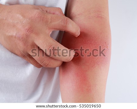 Allergic rash dermatitis eczema skin of a male patient Royalty-Free Stock Photo #535019650