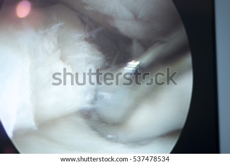 Arthroscopy surgery screen showing arthroscope camera picture in knee meniscus surgical operation to repair injury closeup.