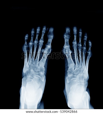 X-ray image of normal foot both side