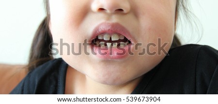 mouth of Asian girl , caries and swelling gum
