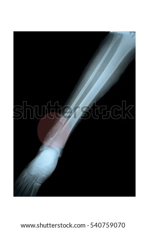 X-ray of the ankle , signs of fracture in the fibula