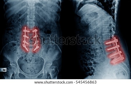 X-ray image of lumbar spine postoperative treatment for degenerative lumbar disc disease
by decompression and fix by iron rod and screws