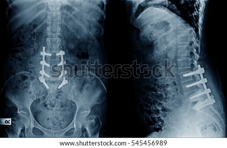 X-ray image of lumbar spine postoperative treatment for degenerative lumbar disc disease
by decompression and fix by iron rod and screws