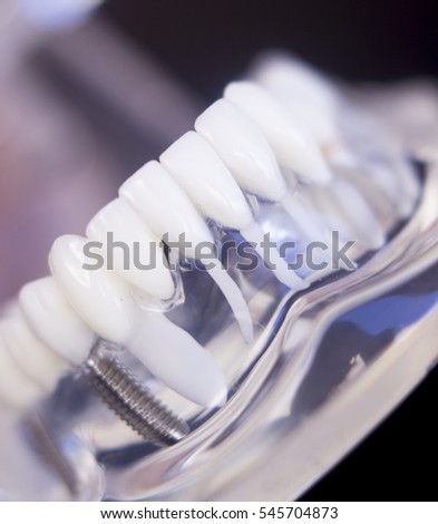 Dentists tooth plastic model with screw implant for teaching, learning and patients in dental office showing teeth and gums.