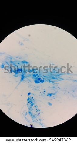 Microbacterium tuberculosis from sputum