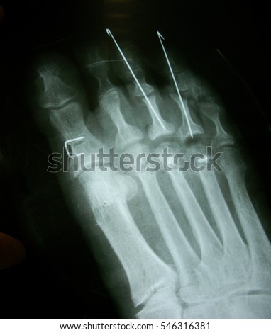 x ray , x-ray image photo of feet front view with a clove after fracture
