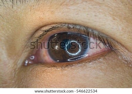 close up of eye infection during eye examination. conjunctivitis, episcleritis.