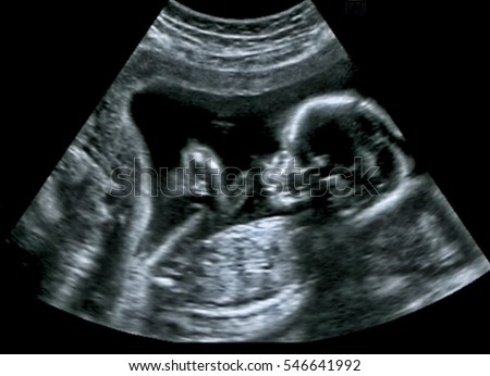 Ultrasound of baby in mother's womb. Royalty-Free Stock Photo #546641992